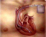 имплантируемый дефибриллятор