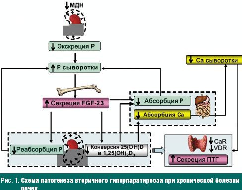 Схема механизмов развития кальциноза паренхиматозных органов при гиперпаратиреозе