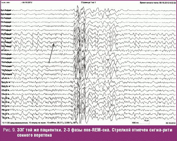 Ээг сна. Сонные веретена на ЭЭГ. Сонные веретена и к-комплексы на ЭЭГ. Эпи-паттерны на ЭЭГ. ЭЭГ головного мозга сонные веретена.