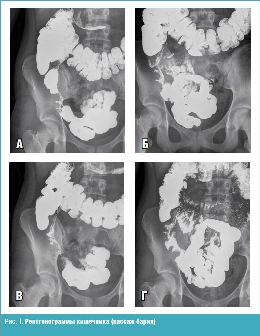 Пассаж кишки. Непроходимость тонкого кишечника рентген. Инвагинация тонкого кишечника Пассаж рентген. Пассаж бария по тонкому кишечнику рентген. Пассаж бариевой взвеси по кишечнику.