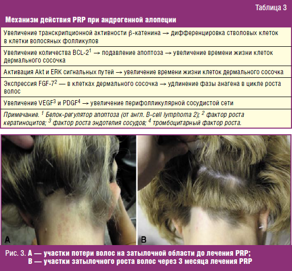 Лечение диффузной алопеции у женщин препараты схема