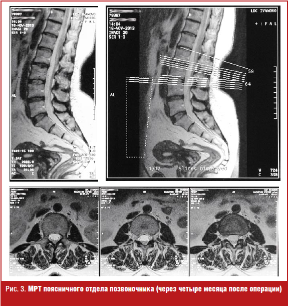 Мрт Поясничного Отдела Позвоночника Цена