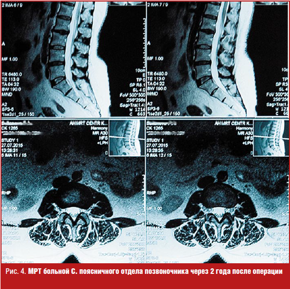Мр картина дегенеративных. Дорсопатия пояснично-крестцового отдела позвоночника. Дорсопатия поясничного отдела. Дорсопатии поясничного отдела позвоночника. Диагноз дорсопатия поясничного отдела позвоночника.