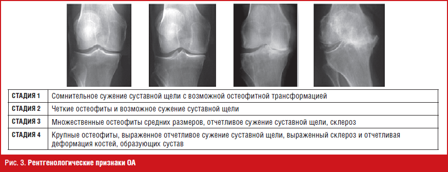 Артроз стадии