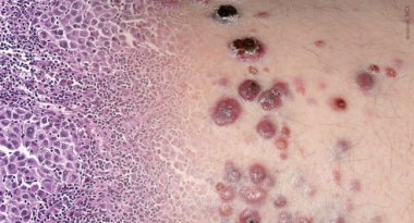 Неоадъювантная терапия: новый подход в лечении меланомы кожи