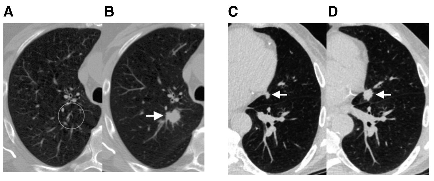Не только диагностировать, но и предотвращать: может ли искусственный интеллект предсказать риск развития рака