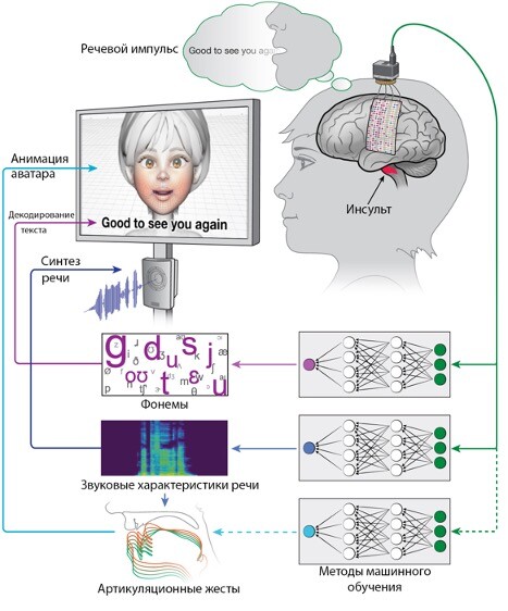 Использование искусственного интеллекта позволило вернуть речь при параличе