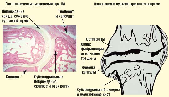 Наиболее яркая картина синовита с частыми обострениями наблюдается при остеоартрозе